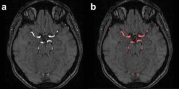 Integrated registry platform boosts heart and stroke research