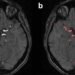 Integrated registry platform boosts heart and stroke research